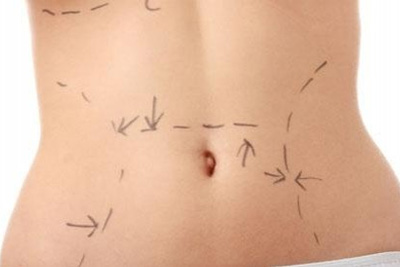 Abdominoplastia