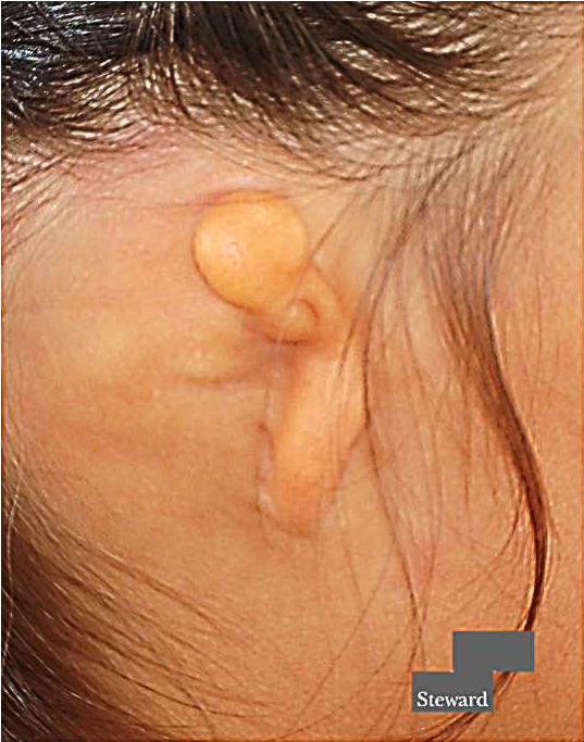 Microtia Antes